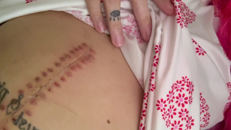 Nali Marie: Scar fetishes ameliyattan sonra hastane iyileşmesi için staples'i dikiş atıyor...