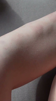 Eu Te Mostro Os Hematomas Nas Minhas Pernas Depois De Sexo