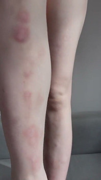 I Show You the Bruises on My Legs After Rough Sex
