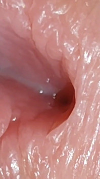Inserting the Super Glue Through the Boy's Glans.