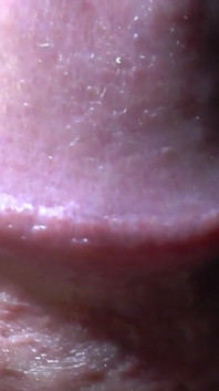 Tayson's glands or pearly papules