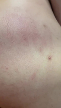 Ještě nemá puchýře nebo nemá nahnutou kuřátku.