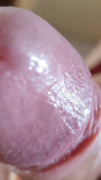 Opening the Scar of the Rough Frenulum!