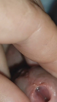 La polla tuvo que ser implantada lentamente