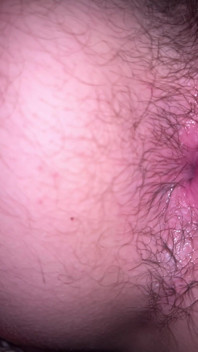 Bruised Asshole