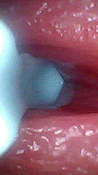 Non Sono Riuscito a Credere Quello Che Accade All'interno Del Pene Quando Lo Sperma Passa (filmati Endoscopici)