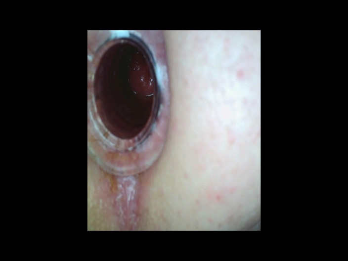 bigears: Anal gape extremo close-up visualizações