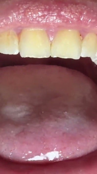 Mouth & Tonsils Close-up