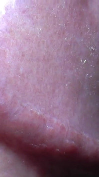 Tayson's glands or pearly papules
