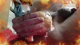 Extrema inserção do glutão