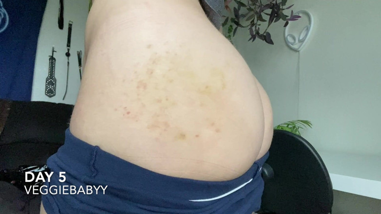 Veggiebabyy: Proses penyembuhan punggung lebam dipukul