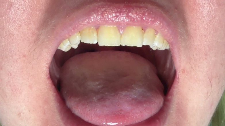 Spunk Kip: Mouth &amp; Tonsils Close-up