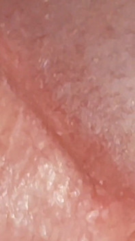 Enlargement of the Deep Urethral Hole!!