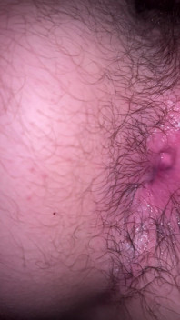 Bruised Asshole