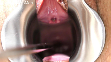 TripleXTransMan: Je pénètre mon col de l’utérus !