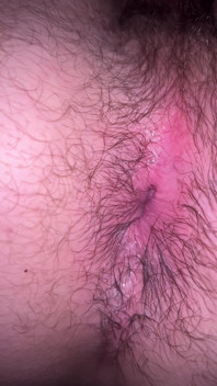 Bruised Asshole
