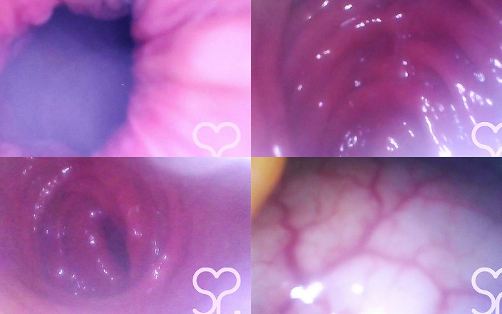 Lina Free: Anale endoscoop helemaal in mijn transverse colon!
