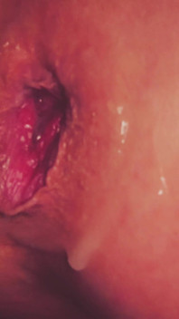 Dilatation Anal