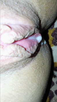 Chảy tràn tinh dịch