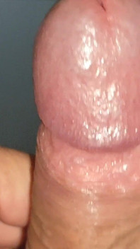 Large Deformed Cock with Lumpy Glans.