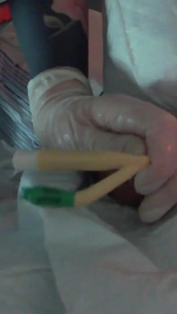 Diubahsuai Bahagian 1 - Stapling up the Mangina