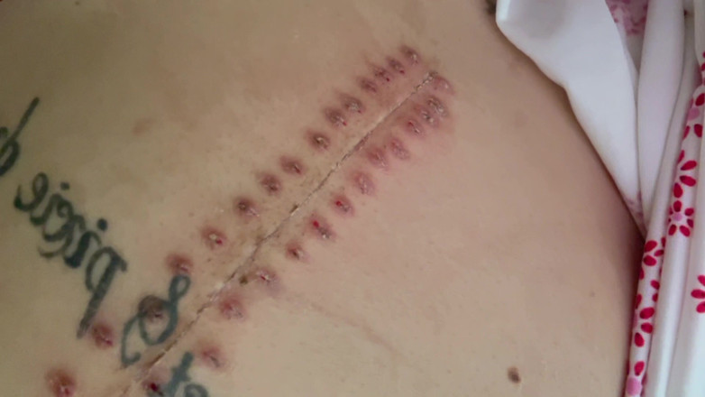 Nali Marie: Scar Fetishes Stitches Staples Hospital Recovery After Surgery Teen Petite...