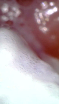 Medisch Endoscoop Mondeling Onderzoek: Gummy Kauwen, Extreme Tanden & Tongmacro