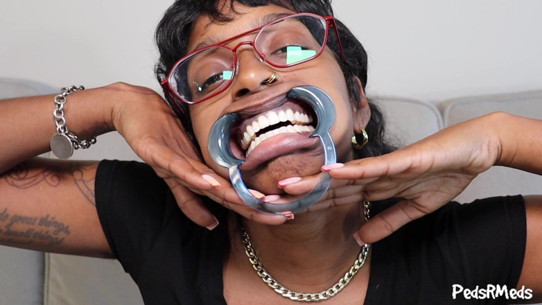 PedsRMeds: Youronlyphoenix Dental Retractor Usta wycieczka