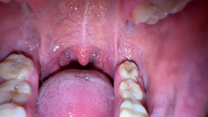 Hottie goddess: Rahsia mulut: lapisan putih tebal pada lidah saya