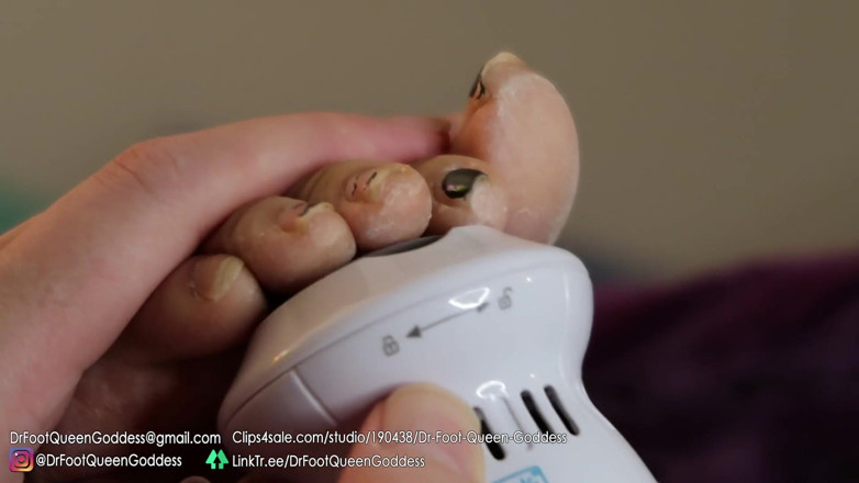 Dr. Foot Queen Goddess: ขูดเท้าด้วยไข่ขูดเท้า ตอนที่ 1