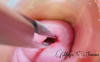 Cervix Without Extreme Dilation