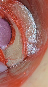 Female Insemination - Internal Camera Captures Deep Male Huge Ejaculation