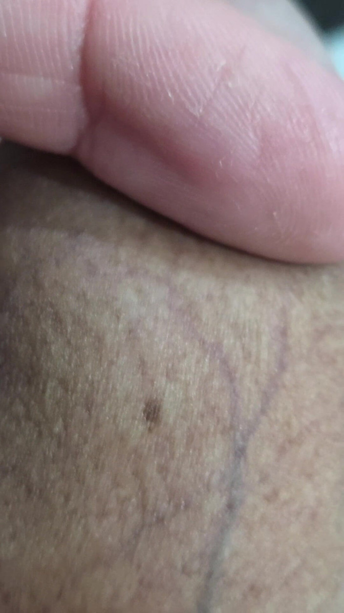 Lkdick8: Quelles sont ces taches sur mon pénis