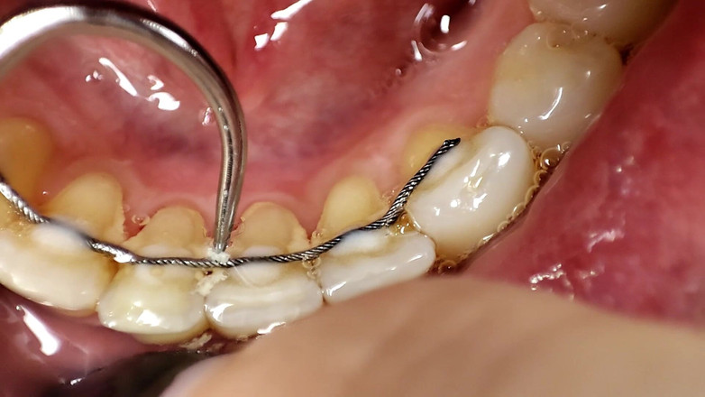 Princess18_: Чистка зубов с помощью зубной щетки, ирригатором, стоматологическим крюком