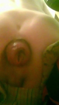 A Young Guy Is Sitting on a Chair with Anal Prolapse