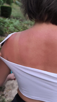 She Really Likes to Sunburn