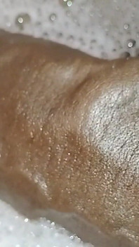 Thick Veins on Cms BBC