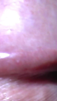 Tayson's glands or pearly papules