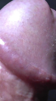 Tayson's glands or pearly papules