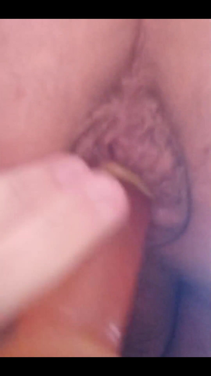 Juliaporno3: Io irritante la mia rosa emorroidea al punto di prolasso...