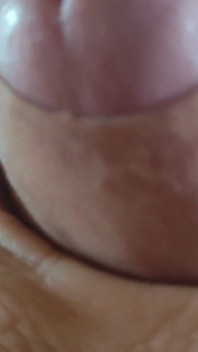 Scarred Frenulum Causes Glans Erection!