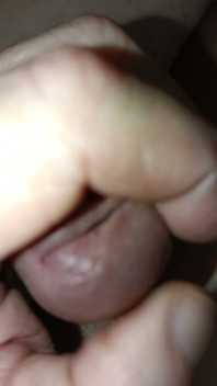 Is My Meatus Open?