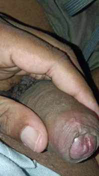 Urine Infection