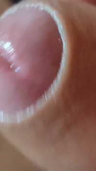 Deep Split in the Glans Produces Bubbling Liquid
