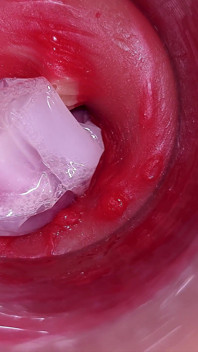The Camera Inside the Deep Pussy Records a Huge Ejaculation with a Stuck Condom!