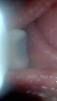 Endoscoopcamera toont de meest gevoelige delen van de penis educatieve video