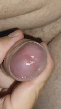 Phimosis Glued to the Glans Prevents Loading During Ejaculation.