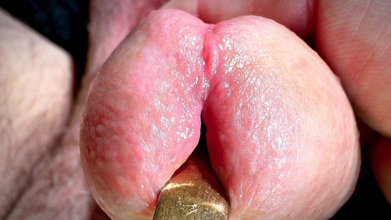 Leonardo-1974: Złota łyżka w penisie