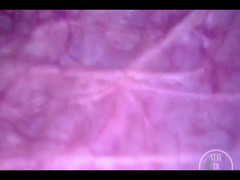 Lina Free: POV-endoskopische katheter-blaseninblasenung!
