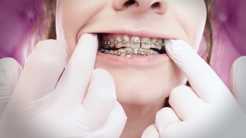 Arya Grander: Asmr: kawat gigi yang ditingkatkan dengan gelang karet chain-link dan...